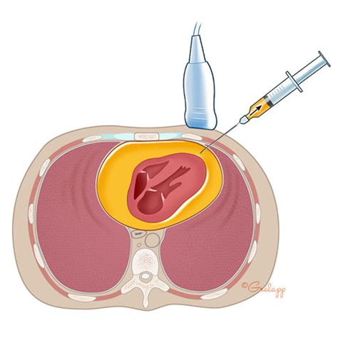 Pericardiocentesis Procedure - Ultrasound-Guided Technique