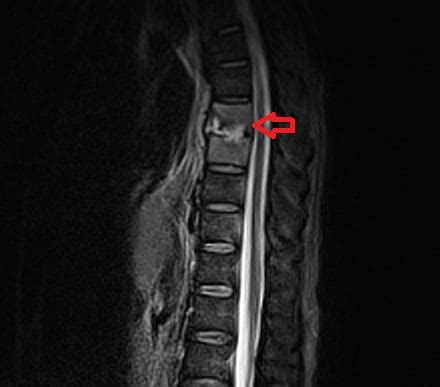 MRI Spine Pathology | How to report an MRI Spine scan