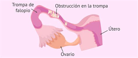 Trompas De Falopio Obstruidas Tratamiento Natural - agentstips