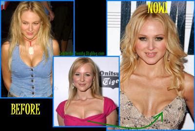 Jewel Plastic Surgery Before and After Breast Implants | Plastic Surgery