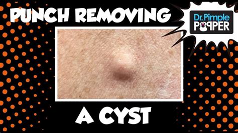 A Punch Removal of a Cyst! With Dr Pimple Popper - YouTube