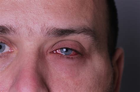 Invasive Fungal Sinusitis Can Threaten Vision Health - Optometry Advisor