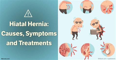 Hiatal Hernia: Causes, Symptoms and Treatment