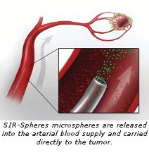 Y90 Radioembolization – VIP Physicians Memphis