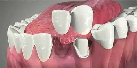 What is a Cantilever Dental Bridge?