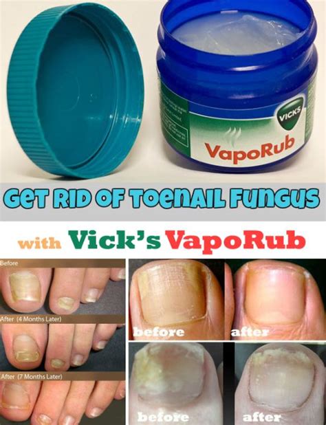 The 25+ best ideas about Toe Fungus Cure on Pinterest | Toenail fungus ...