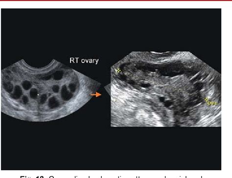 Figure 1 from Baseline Scan and Ultrasound Diagnosis of PCOS | Semantic Scholar