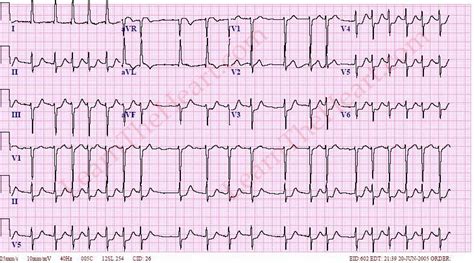 Atrial Fibrillation With Rvr Ecg | Hot Sex Picture