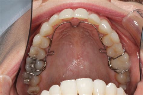 Rapid Palatal Expander: Pro's and Con's - Elizabeth Caughey DDSElizabeth Caughey DDS