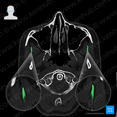 Coronoid process of mandible: Anatomy and function | Kenhub