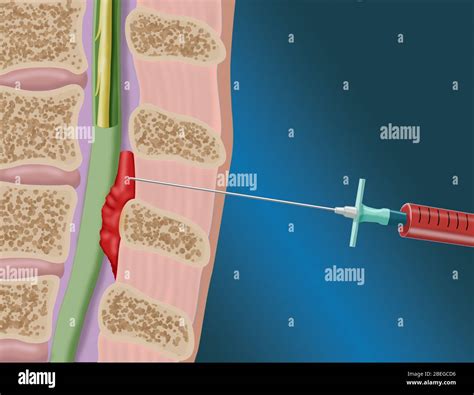 Epidural Blood Patch Procedure, Illustration Stock Photo - Alamy