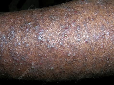 Atopic Eczema On Black Skin