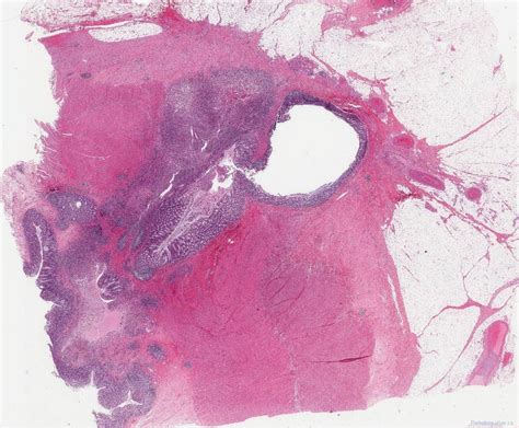 Diverticulitis in the colon | Atlas of Pathology