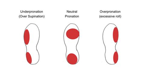 Overpronation Vs Underpronation - Causes, Injuries, & Treatments