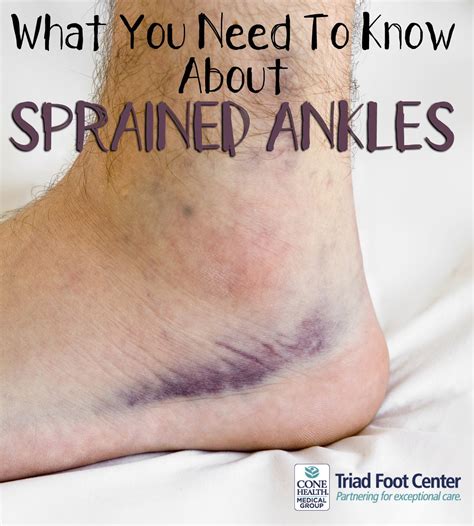 Top 95+ Images Pictures Of A Sprained Foot Excellent