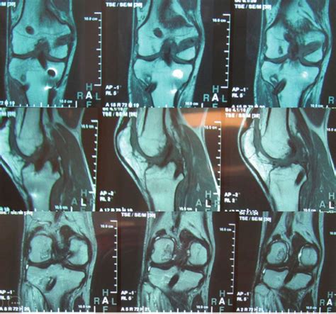 MRI 12 month after PCL and ACL plasty. | Download Scientific Diagram