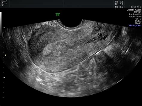 Detecting Endometrial Carcinoma with Ultrasound | Empowered Women's Health