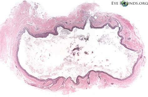 Atlas Entry - Dermoid cyst