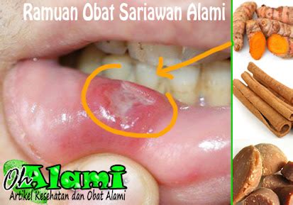 Ramuan Obat Herbal (Bahan Alami) Untuk Mengobati Sariawan