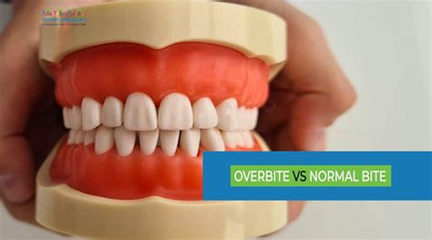 Overbite vs Normal Bite: Differences, Causes, and Treatment