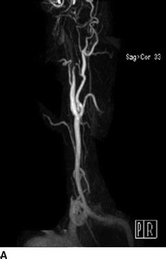 Carotid Artery Dissection | Thoracic Key