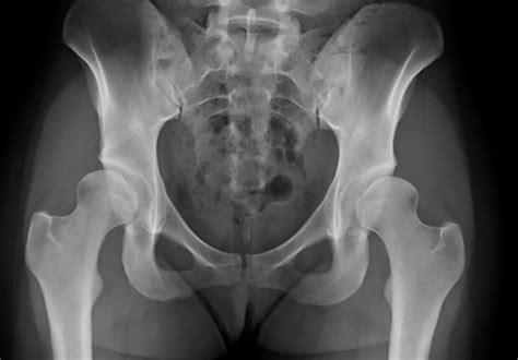 Modern approach to developmental dysplasia of the hip - Mayo Clinic