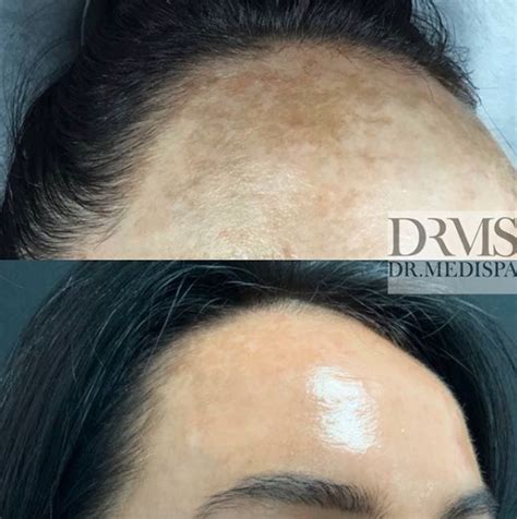 Laser Hyperpigmentation Treatment - Dr MediSpa Award Winning Clinics