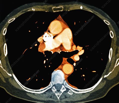 Pulmonary embolism, CT scan - Stock Image - C026/9986 - Science Photo Library