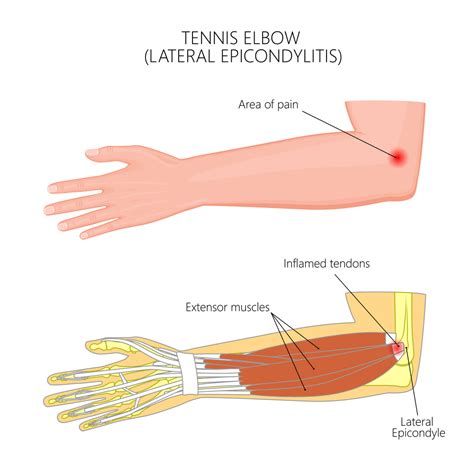 Tennis Elbow Treatment Brisbane - Knead Myotherapy- Get Results