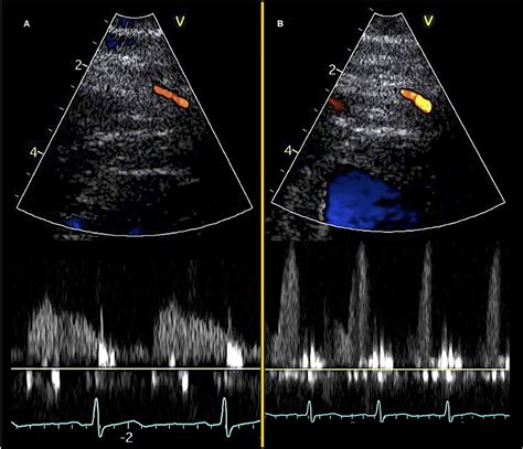 Frontiers | Doppler Echocardiography Assessment of Coronary Microvascular Function in Patients ...