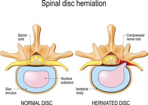 Cervical Disc Herniation | Upswing Health