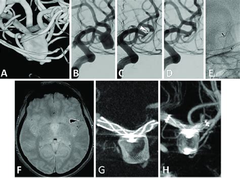 Patient17: unruptured left middle cerebral artery (MCA) aneurysm. (A)... | Download Scientific ...