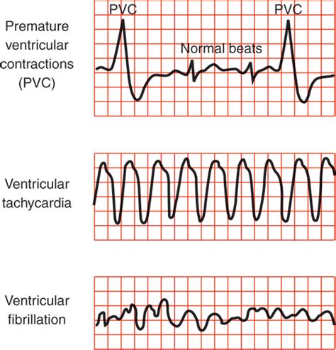 Premature Ventricular Contractions Pvcs Symptoms Premature | Images and ...