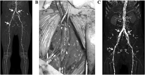 Femoral Endarterectomy Procedure