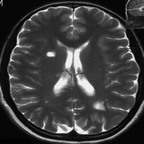 (PDF) Morning glory syndrome associated with multiple sclerosis