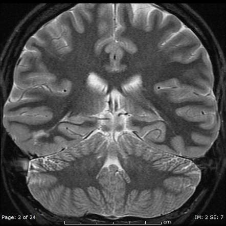 Focal cortical dysplasia | Radiology Reference Article | Radiopaedia.org