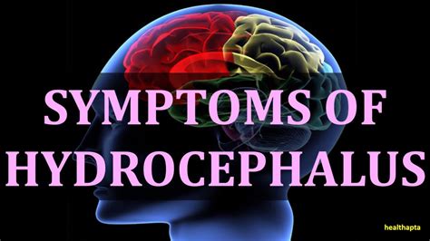 SYMPTOMS OF HYDROCEPHALUS - YouTube