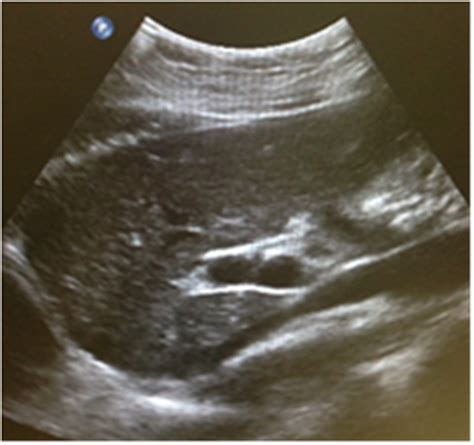 Ultrasound in the assessment of hepatomegaly: A simple technique to determine an enlarged liver ...