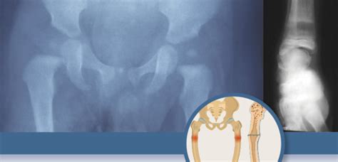 Hypophosphatemia: Diagnosis, Evaluation, and Treatment-Enduring