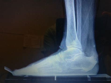 Achilles Bone Spur Surgery Recovery Time [6-8 Weeks Best Treatment]