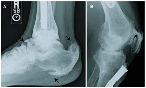 Enthesophytes at the site of enthesis attachment to the plantar aspect of the calcaneus are ...