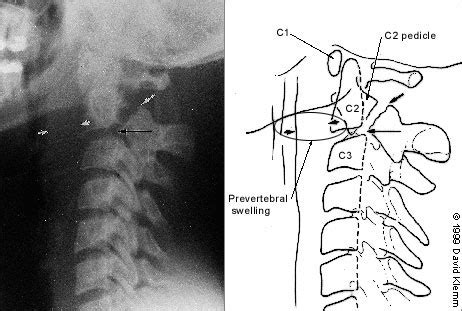 Jefferson Fracture Xray