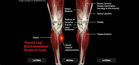 Tennis Leg (Gastrocnemius Strain or Tear) – Thermoskin – Supports and braces for injury and pain ...