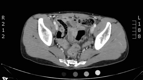 Appendicitis On Ct Scan