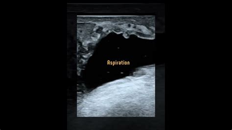 Spermatocele Ultrasound