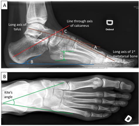 Subtelna stopa Cavovarusa: A Missed Risk Factor for Chronic Foot and Ankle Pathologies | Tomas ...