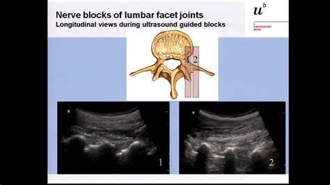 Lumbar Medial Branch Nerve Block