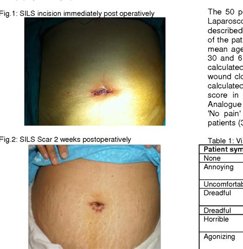 Laparoscopic Cholecystectomy Incisions