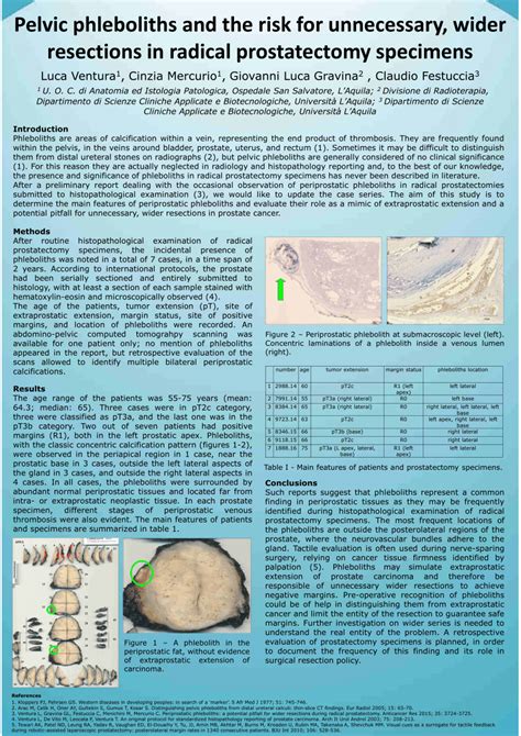 Download PDF | Pelvic phleboliths and the risk for unnecessary, wider resections in radical ...