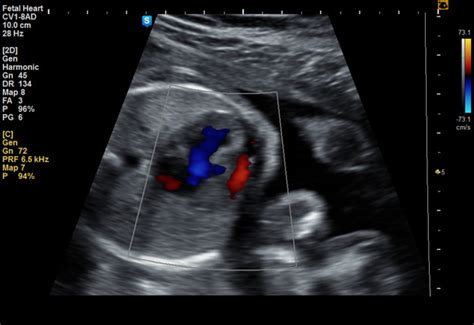 Atrioventricular Septal Defect Ultrasound